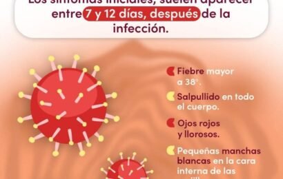 Medidas de prevención reducen riesgos de contagio de sarampión Medidas de prevención reducen riesgos de contagio de sarampión