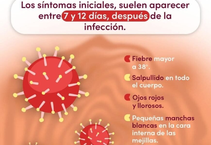 Medidas de prevención reducen riesgos de contagio de sarampión Medidas de prevención reducen riesgos de contagio de sarampión